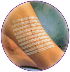 Sutures cutanées adhésives stériles 3M™ Steri-Strip™